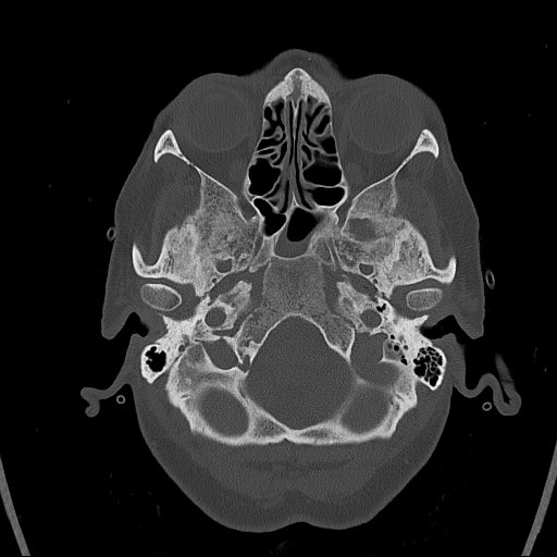 Cerebral venous infarction with hemorrhage (Radiopaedia 65343-74381 Axial bone window 13).jpg
