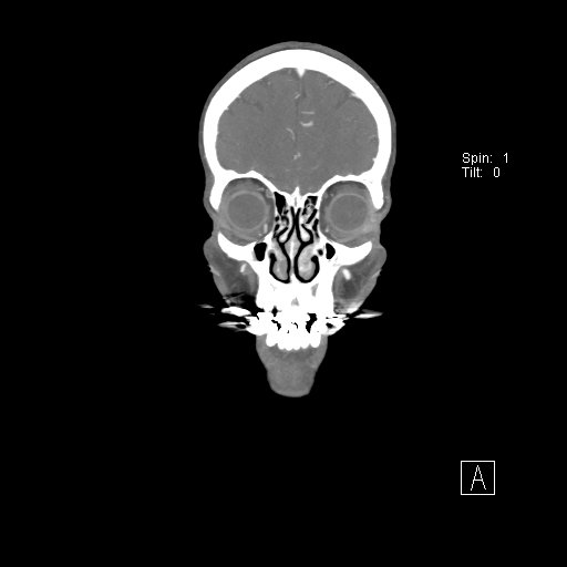 File:Cerebral venous infarction with hemorrhage (Radiopaedia 65343-74396 B 43).jpg