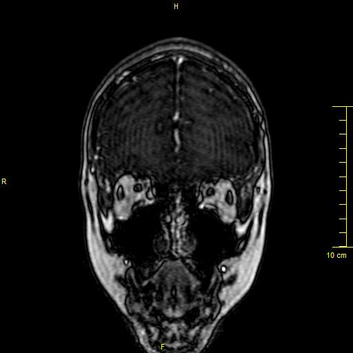 File:Cerebral venous thrombosis (Radiopaedia 23288-23351 MRV 10).JPG