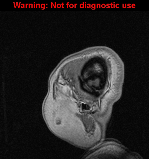 Cerebral venous thrombosis (Radiopaedia 37224-39208 Sagittal T1 C+ 9).jpg