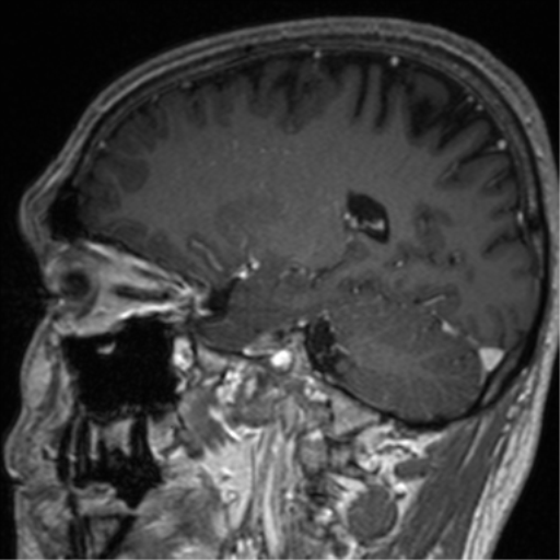 Cerebral venous thrombosis (Radiopaedia 38392-40469 Sagittal T1 C+ 34).png