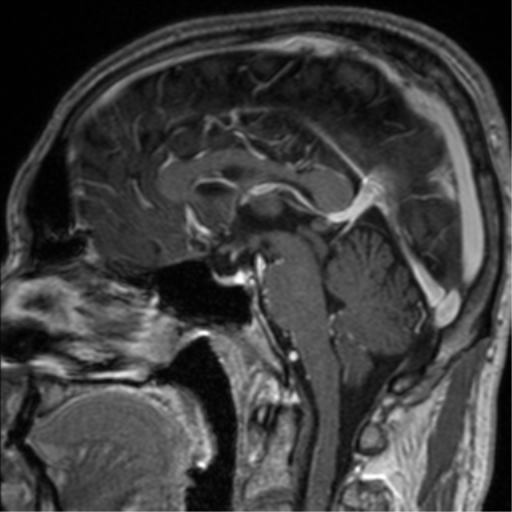 Cerebral venous thrombosis (Radiopaedia 38392-40469 Sagittal T1 C+ 46).png