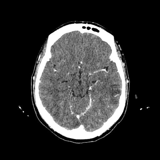 File:Cerebral venous thrombosis with venous hemorrhagic infarct (Radiopaedia 90354-107660 Axial with contrast 69).jpg