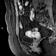 File:Cervical adenocarcinoma (Radiopaedia 65011-73985 E 7).jpg
