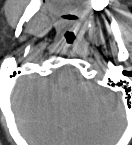 File:Cervical canal stenosis - OPLL and osteophytes (Radiopaedia 47329-51910 Axial non-contrast 6).png