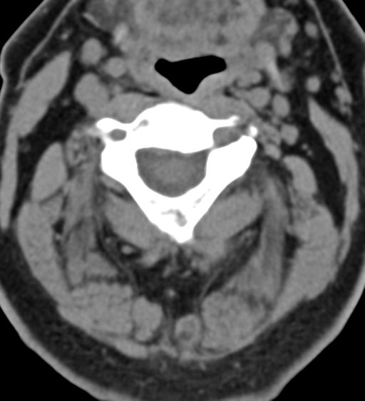 File:Cervical canal stenosis due to ossification of the posterior longitudinal ligament (Radiopaedia 47260-51823 Axial non-contrast 22).png