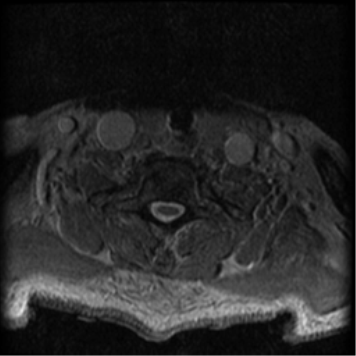File:Cervical canal stenosis with cord compression (Radiopaedia 34114-35374 Axial Gradient Echo 18).png