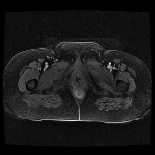 File:Cervical carcinoma (Radiopaedia 70924-81132 Axial T1 C+ fat sat 19).jpg