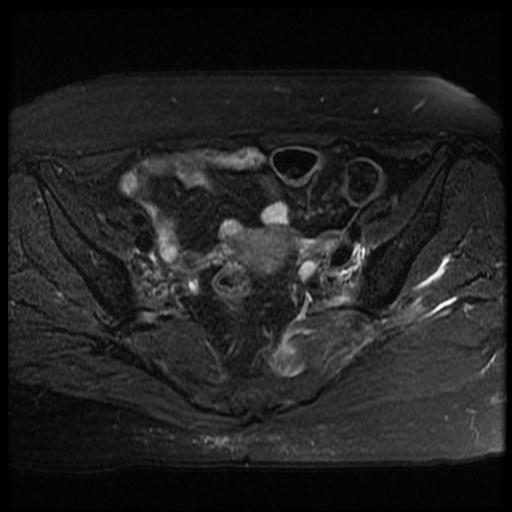 File:Cervical carcinoma (Radiopaedia 70924-81132 Axial T2 fat sat 3).jpg