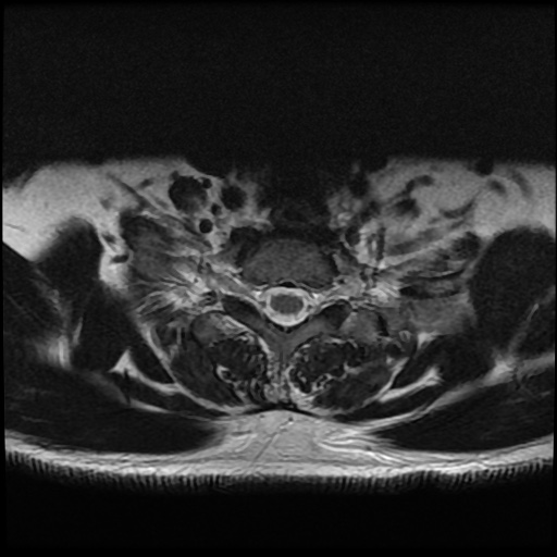 File:Cervical disc extrusion (Radiopaedia 59074-66364 Axial T2 18).jpg