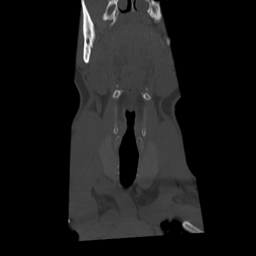 Cervical schwannoma (Radiopaedia 57979-64974 Coronal bone window 10).png
