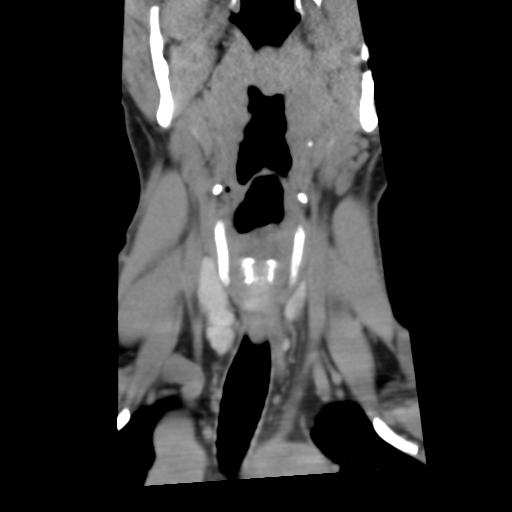 File:Cervical schwannoma (Radiopaedia 57979-64974 Coronal non-contrast 11).png