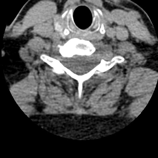 File:Cervical spinal neurofibroma in a patient with NF1 (Radiopaedia 58344-65464 Axial non-contrast 56).jpg