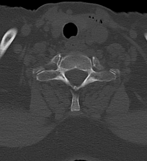 Cervical spine ACDF loosening (Radiopaedia 48998-54070 Axial bone window 48).png