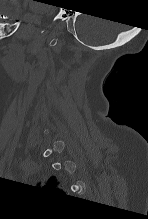 Cervical spine ACDF loosening (Radiopaedia 48998-54070 Sagittal bone window 66).png