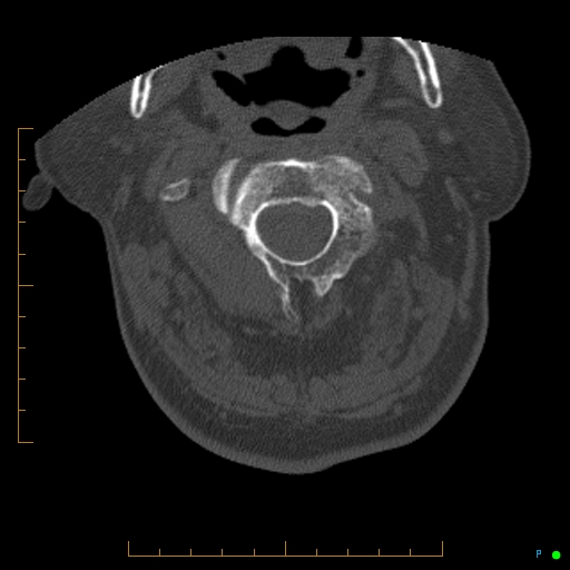File:Cervical spine fracture - ankylosing spondylitis (Radiopaedia 76835-88706 Axial bone window 51).jpg