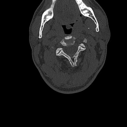 Cervical spine trauma with tear drop fracture and perched facet joint (Radiopaedia 53989-60127 Axial bone window 51).jpg