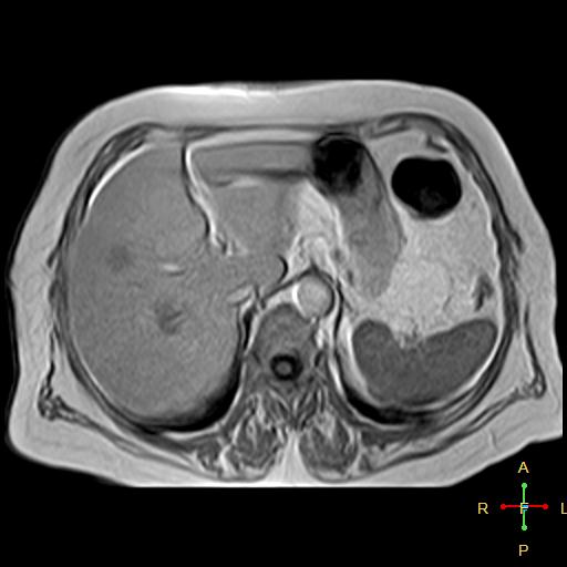 File:Cervical stump squamous cell carcinoma (Radiopaedia 48049-52858 H 11).jpg