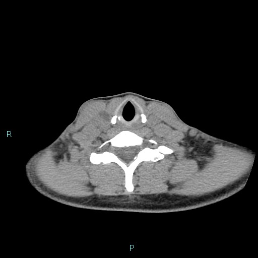 File:Cervical thymic cyst (Radiopaedia 88632-105335 Axial non-contrast 45).jpg