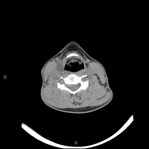 Cervical thymic cyst (Radiopaedia 88632-105335 Axial non-contrast 57).jpg
