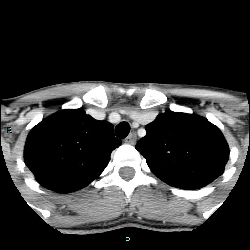 Cervical thymic cyst (Radiopaedia 88632-105335 C 15).jpg