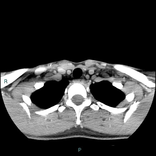 Cervical thymic cyst (Radiopaedia 88632-105335 C 30).jpg