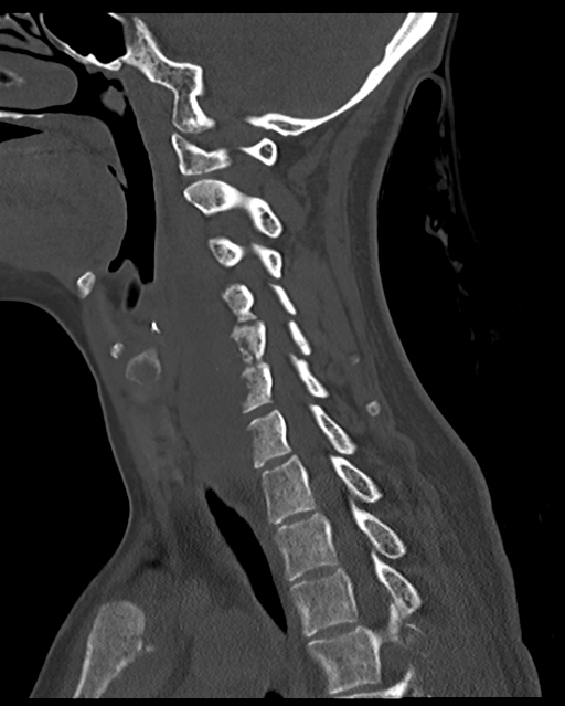 Cervical tuberculous spondylitis (Radiopaedia 39149-41365 Sagittal bone window 29).png