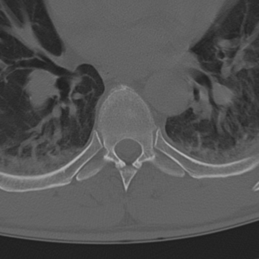 Chance fracture (Radiopaedia 33854-35020 Axial bone window 44).png