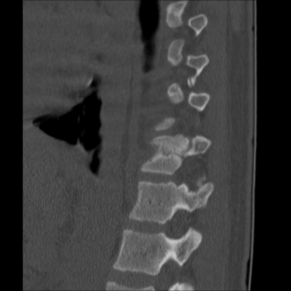Chance fracture (Radiopaedia 36521-38081 Sagittal bone window 51).jpg