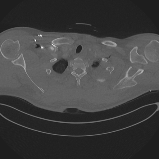 Chest multitrauma - aortic injury (Radiopaedia 34708-36147 Axial bone window 29).png