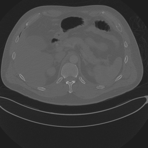 Chest multitrauma - aortic injury (Radiopaedia 34708-36147 Axial bone window 300).png