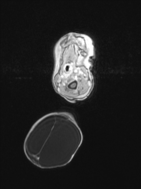 Chiari III malformation with occipital encephalocele (Radiopaedia 79446-92559 Axial T1 C+ mpr 19).jpg
