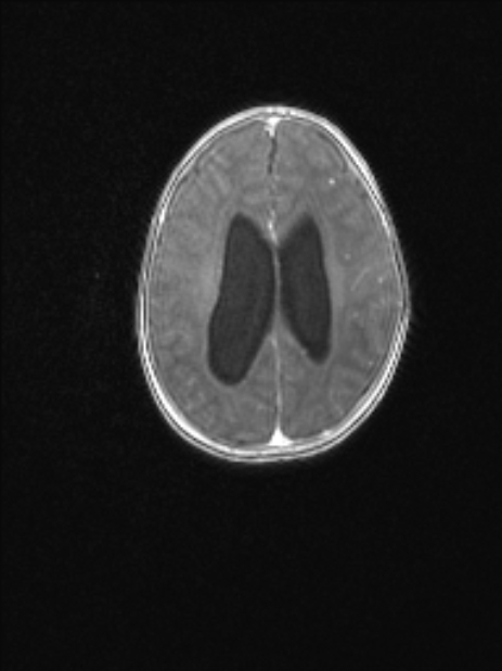 Chiari III malformation with occipital encephalocele (Radiopaedia 79446-92559 Axial T1 C+ mpr 62).jpg