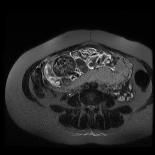 Chiari II malformation - fetal MRI (Radiopaedia 68099-77581 Axial T2-SSFSE 13).jpg