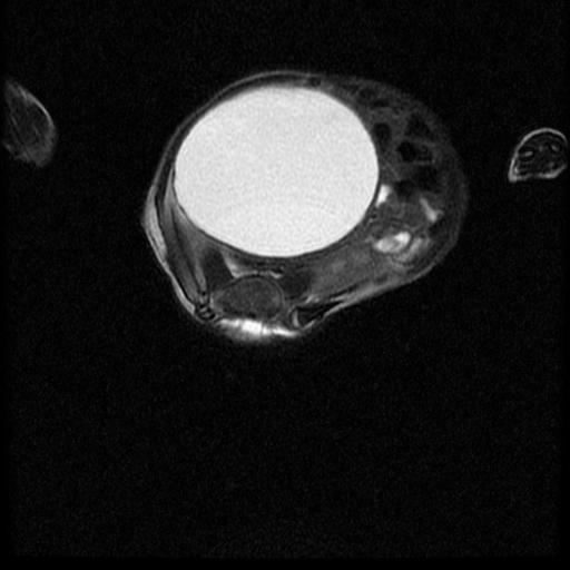 File:Chiari II malformation with spinal meningomyelocele (Radiopaedia 23550-23652 Axial T2 14).jpg