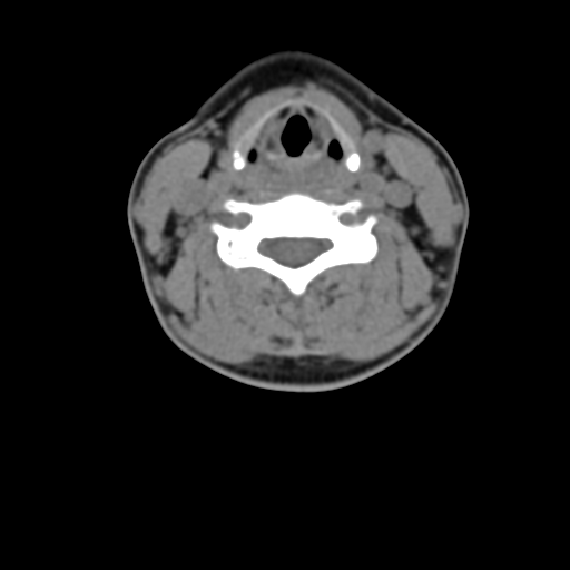 Chiari I malformation and obstructive hydrocephalus (Radiopaedia 41185-43981 D 57).png
