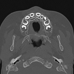 File:Choanal atresia (Radiopaedia 88525-105975 Axial bone window 4).jpg