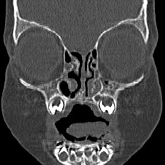 File:Choanal atresia (Radiopaedia 88525-105975 Coronal bone window 18).jpg