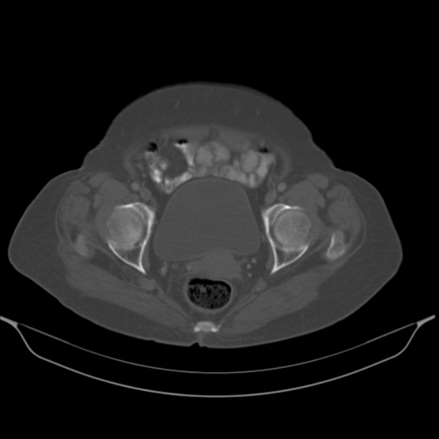 Cholangiocarcinoma (Radiopaedia 50592-56025 Axial bone window 67).jpg