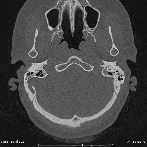 Cholesteatoma - external auditory canal (Radiopaedia 88452-105096 Axial bone window 22).jpg