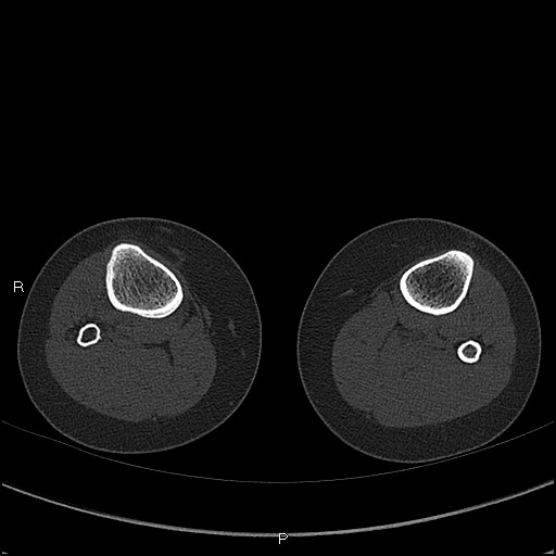 Chondroblastoma (Radiopaedia 62721-71030 Axial bone window 103).jpg