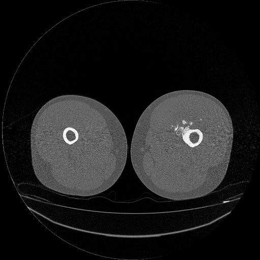 File:Chondrosarcoma arising from exostosis (Radiopaedia 59996-67507 Axial bone window 4).jpg