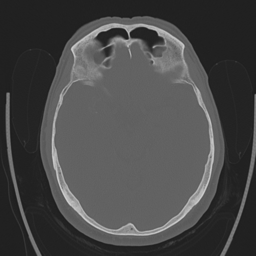 Chondrosarcoma of skull base- grade II (Radiopaedia 40948-43653 Axial bone window 19).png