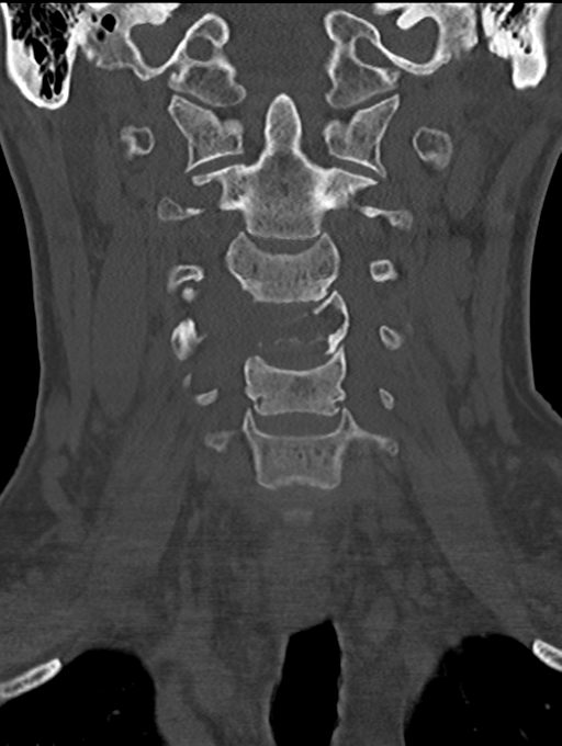 Chordoma (C4 vertebra) (Radiopaedia 47561-52188 Coronal bone window 18).png