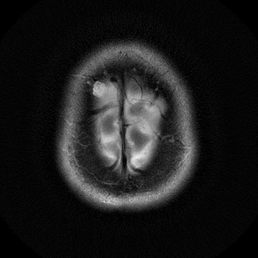 File:Choroid plexus xanthogranuloma (Radiopaedia 17650-17386 T2 1).jpg