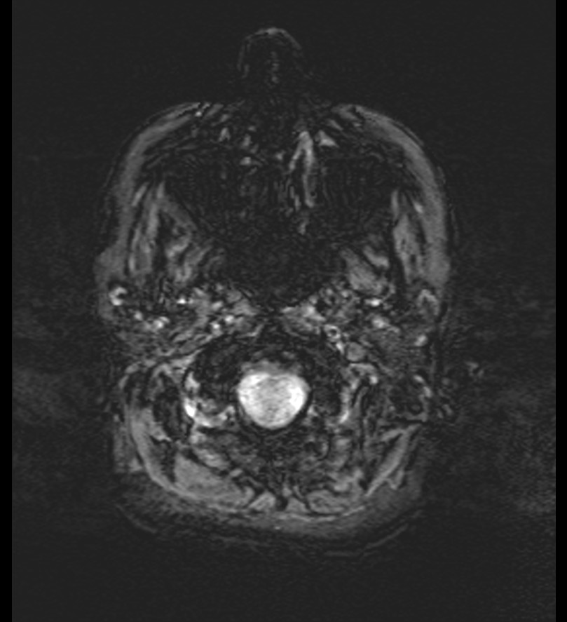 Choroid plexus xanthogranuloma (Radiopaedia 91271-108875 Axial SWI 4).jpg