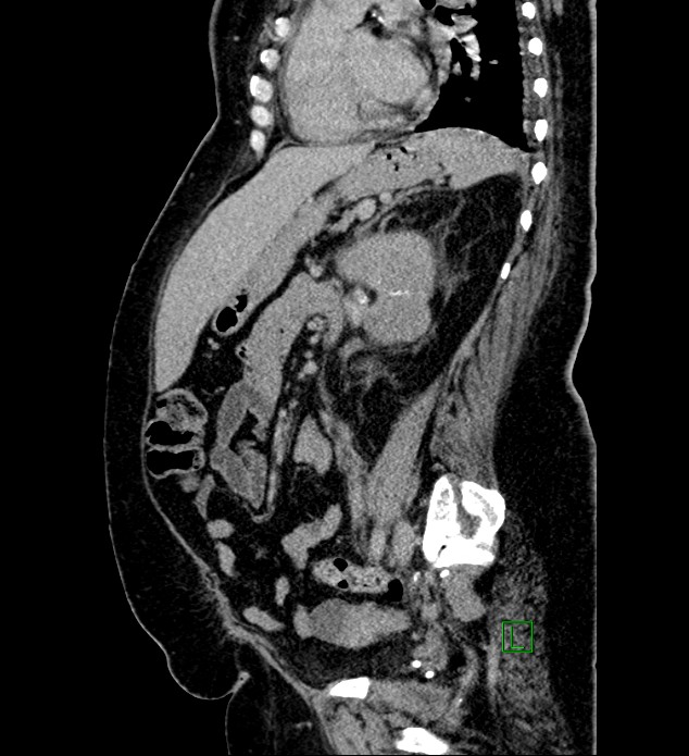 Chromophobe renal cell carcinoma (Radiopaedia 84239-99519 G 48).jpg