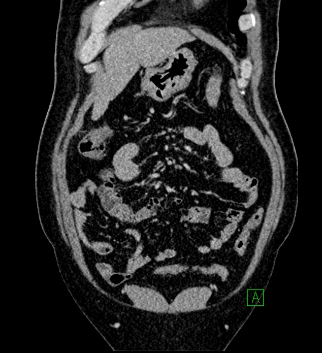 Chromophobe renal cell carcinoma (Radiopaedia 84286-99573 H 43).jpg
