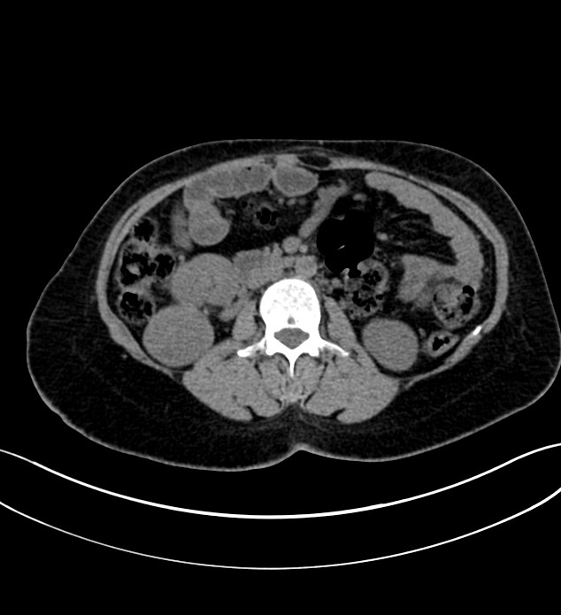 Chromophobe renal cell carcinoma (Radiopaedia 84290-99582 Axial non-contrast 68).jpg
