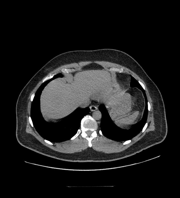 Chromophobe renal cell carcinoma (Radiopaedia 84337-99644 Axial non-contrast 9).jpg